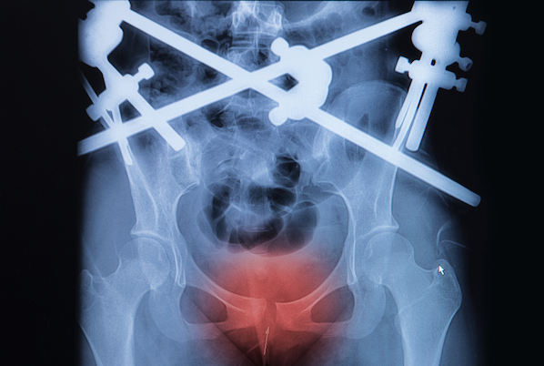 Pelvic fractures